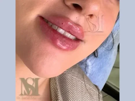 همه چیز درباره تزریق فیلر لب